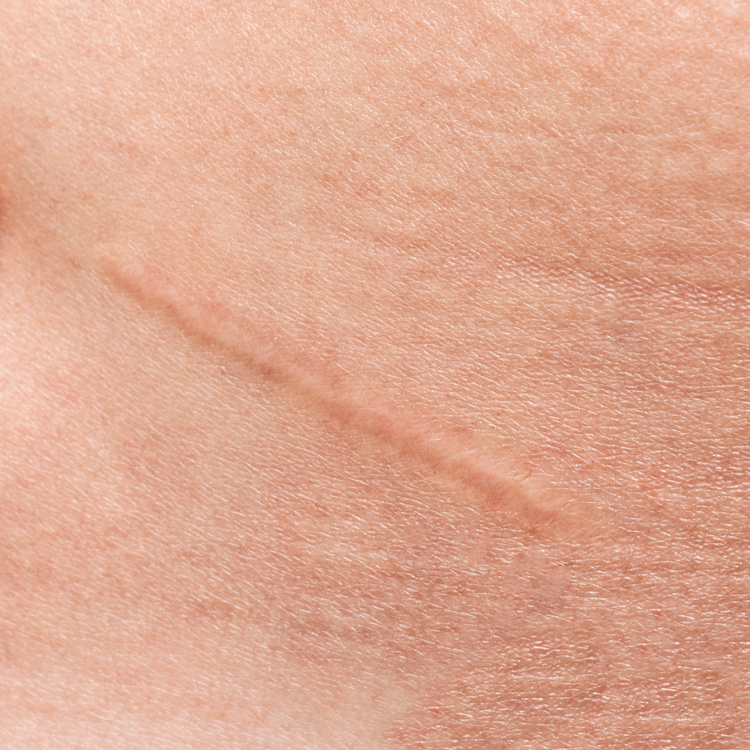 Dra. Eveline Zanetti, Dra Eveline Zanetti Juiz de Fora, Eveline Zanetti nutróloga, Eveline Zanetti nutrologia Juiz de Fora, médica nutróloga Juiz de Fora, nutrologia em Juiz de Fora, nutróloga em Juiz de Fora, médico nutrólogo em Juiz de Fora, nutrologia clínica em Juiz de Fora, emagrecimento com médico em Juiz de Fora, emagrecimento saudável em Juiz de Fora, dieta para emagrecimento, dieta para emagrecer com saúde, dieta para perda de peso, tratamento da obesidade em Juiz de Fora, acompanhamento nutrológico em Juiz de Fora, tratamento de lipedema em Juiz de Fora, lipedema Juiz de Fora, nutrologia para lipedema, acompanhamento pré-operatório em Juiz de Fora, acompanhamento pós-operatório em Juiz de Fora, melhora da cicatrização em Juiz de Fora, nutrologia para qualidade de vida, consulta nutrologia Juiz de Fora, atendimento particular nutrologia Juiz de Fora, nutrologia online, consulta online nutrologia, emagrecimento médico, dieta orientada por médico, acompanhamento nutricional médico.