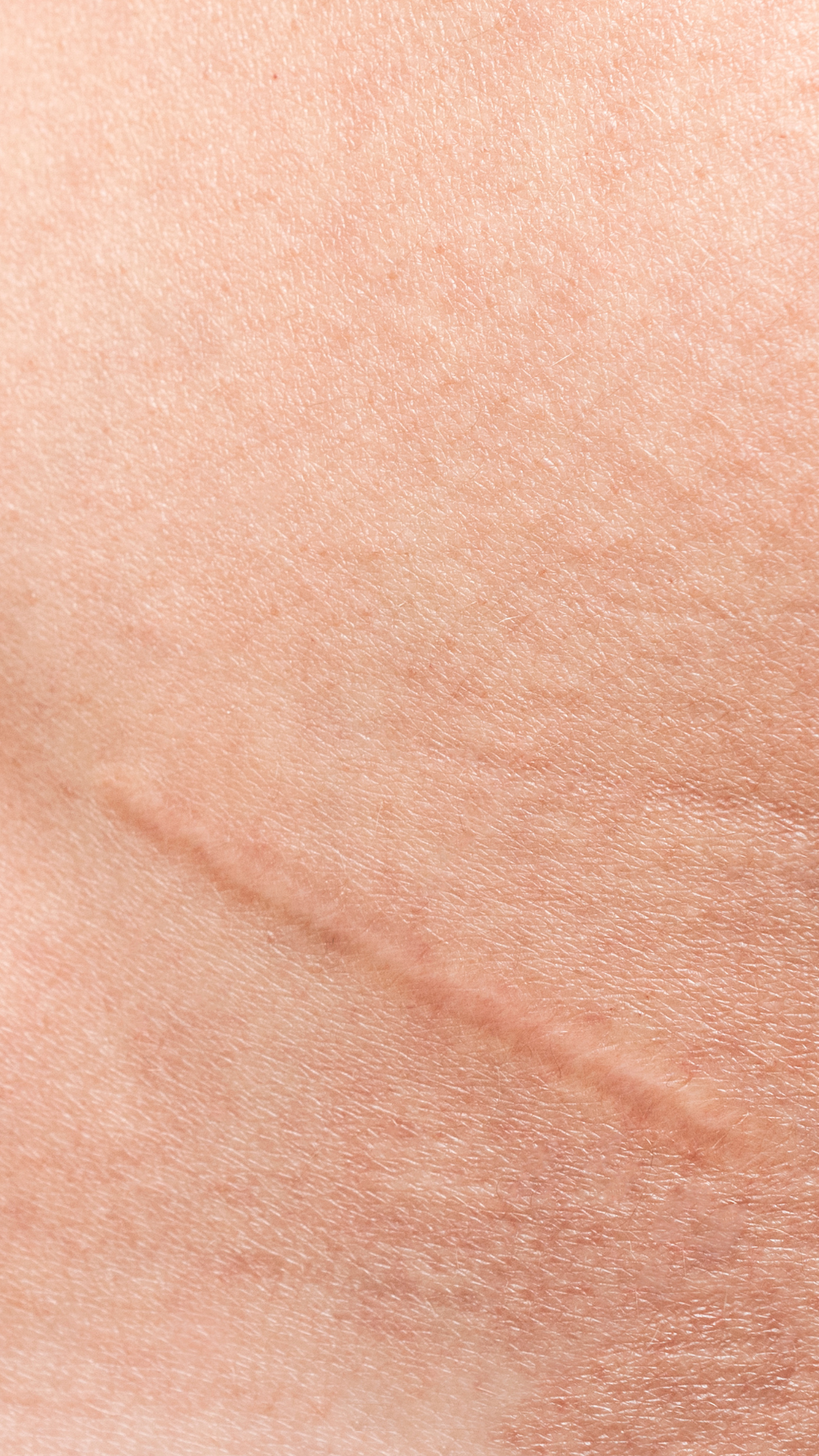 Dra. Eveline Zanetti, Dra Eveline Zanetti Juiz de Fora, Eveline Zanetti nutróloga, Eveline Zanetti nutrologia Juiz de Fora, médica nutróloga Juiz de Fora, nutrologia em Juiz de Fora, nutróloga em Juiz de Fora, médico nutrólogo em Juiz de Fora, nutrologia clínica em Juiz de Fora, emagrecimento com médico em Juiz de Fora, emagrecimento saudável em Juiz de Fora, dieta para emagrecimento, dieta para emagrecer com saúde, dieta para perda de peso, tratamento da obesidade em Juiz de Fora, acompanhamento nutrológico em Juiz de Fora, tratamento de lipedema em Juiz de Fora, lipedema Juiz de Fora, nutrologia para lipedema, acompanhamento pré-operatório em Juiz de Fora, acompanhamento pós-operatório em Juiz de Fora, melhora da cicatrização em Juiz de Fora, nutrologia para qualidade de vida, consulta nutrologia Juiz de Fora, atendimento particular nutrologia Juiz de Fora, nutrologia online, consulta online nutrologia, emagrecimento médico, dieta orientada por médico, acompanhamento nutricional médico.