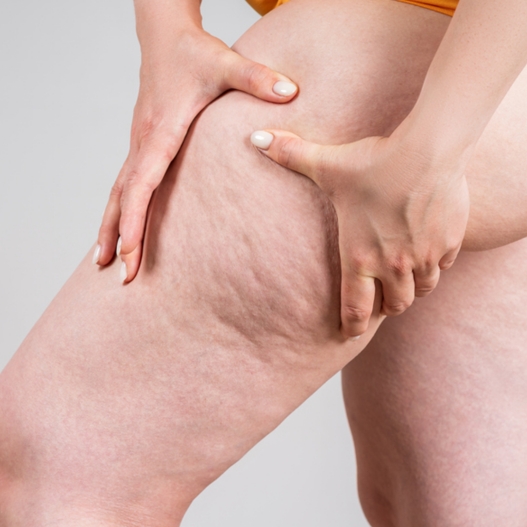 Dra. Eveline Zanetti, Dra Eveline Zanetti Juiz de Fora, Eveline Zanetti nutróloga, Eveline Zanetti nutrologia Juiz de Fora, médica nutróloga Juiz de Fora, nutrologia em Juiz de Fora, nutróloga em Juiz de Fora, médico nutrólogo em Juiz de Fora, nutrologia clínica em Juiz de Fora, emagrecimento com médico em Juiz de Fora, emagrecimento saudável em Juiz de Fora, dieta para emagrecimento, dieta para emagrecer com saúde, dieta para perda de peso, tratamento da obesidade em Juiz de Fora, acompanhamento nutrológico em Juiz de Fora, tratamento de lipedema em Juiz de Fora, lipedema Juiz de Fora, nutrologia para lipedema, acompanhamento pré-operatório em Juiz de Fora, acompanhamento pós-operatório em Juiz de Fora, melhora da cicatrização em Juiz de Fora, nutrologia para qualidade de vida, consulta nutrologia Juiz de Fora, atendimento particular nutrologia Juiz de Fora, nutrologia online, consulta online nutrologia, emagrecimento médico, dieta orientada por médico, acompanhamento nutricional médico.