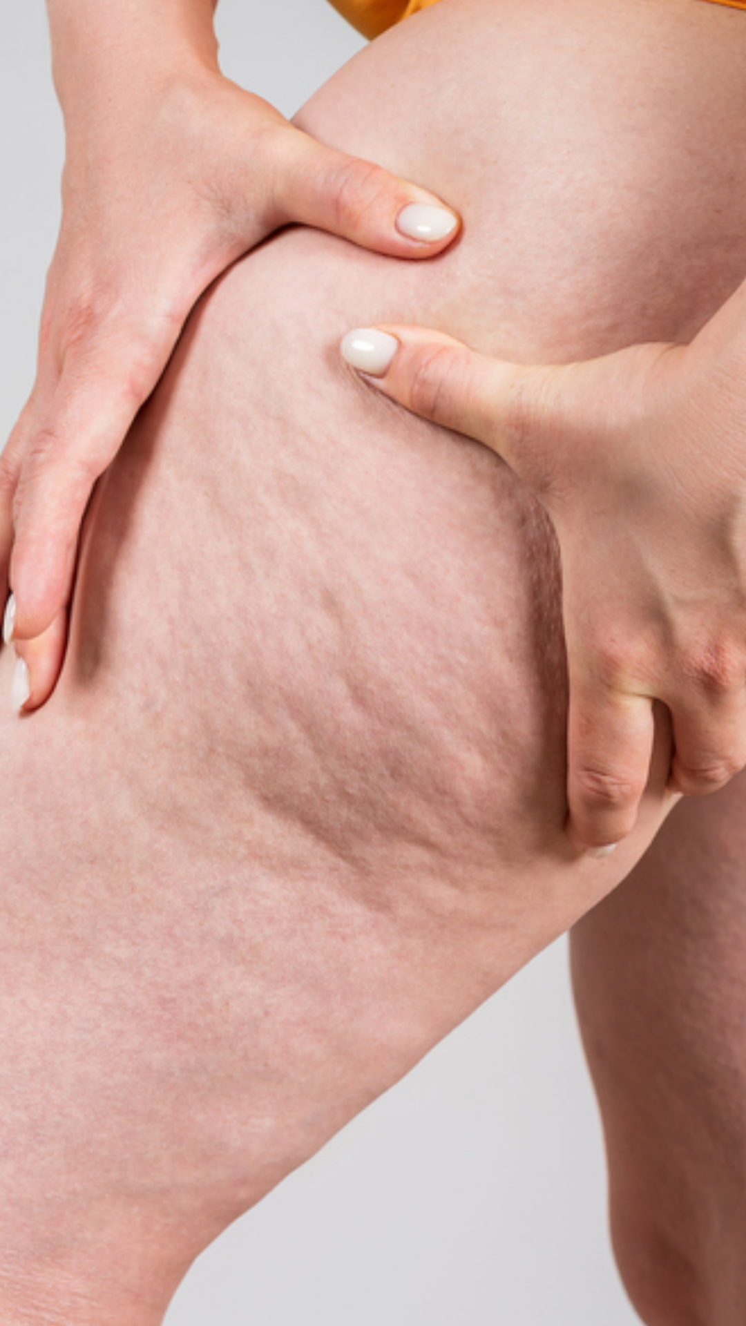 Dra. Eveline Zanetti, Dra Eveline Zanetti Juiz de Fora, Eveline Zanetti nutróloga, Eveline Zanetti nutrologia Juiz de Fora, médica nutróloga Juiz de Fora, nutrologia em Juiz de Fora, nutróloga em Juiz de Fora, médico nutrólogo em Juiz de Fora, nutrologia clínica em Juiz de Fora, emagrecimento com médico em Juiz de Fora, emagrecimento saudável em Juiz de Fora, dieta para emagrecimento, dieta para emagrecer com saúde, dieta para perda de peso, tratamento da obesidade em Juiz de Fora, acompanhamento nutrológico em Juiz de Fora, tratamento de lipedema em Juiz de Fora, lipedema Juiz de Fora, nutrologia para lipedema, acompanhamento pré-operatório em Juiz de Fora, acompanhamento pós-operatório em Juiz de Fora, melhora da cicatrização em Juiz de Fora, nutrologia para qualidade de vida, consulta nutrologia Juiz de Fora, atendimento particular nutrologia Juiz de Fora, nutrologia online, consulta online nutrologia, emagrecimento médico, dieta orientada por médico, acompanhamento nutricional médico.